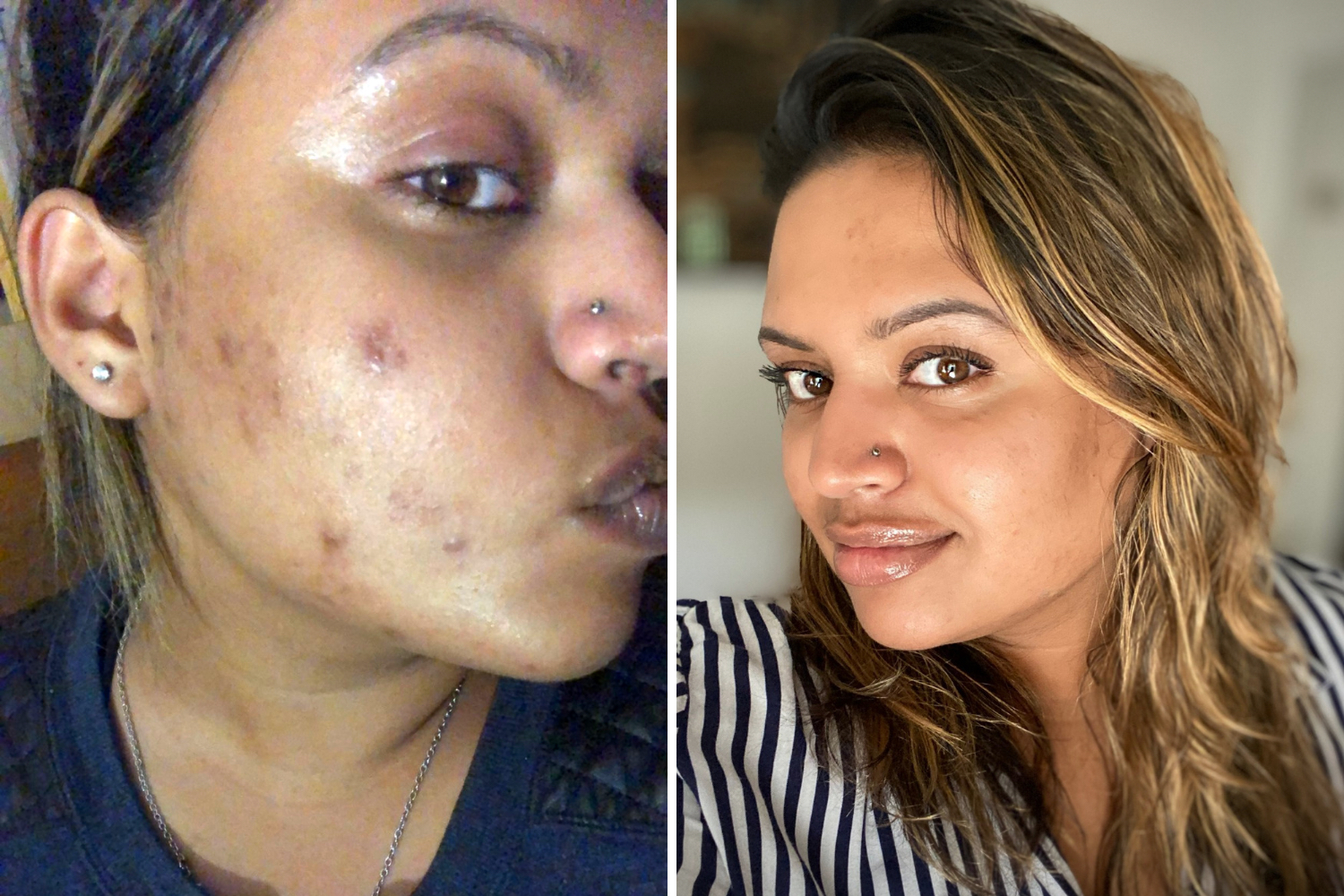 How to Fade Dark Spots and Hyperpigmentation